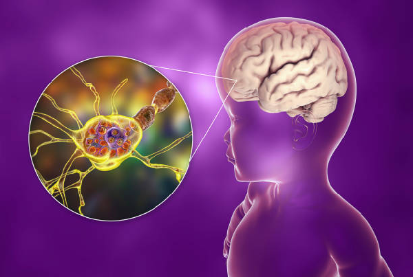 Demyelinating Disorder